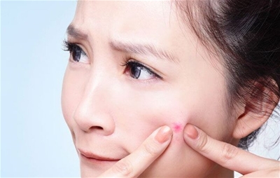 4 cách trị mụn trứng cá hiệu quả nhất ở tuổi dậy thì