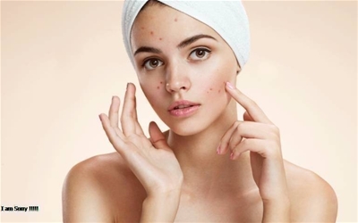 MỤN SẼ KHÔNG CÒN LÀ NỖI LO CỦA BẠN MỖI NGÀY NỮA ?