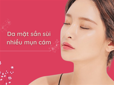 SỮA RỬA MẶT TRỊ MỤN CÁM TỐT NHẤT CHO DA