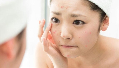 NHỮNG CÁCH GIÚP BẠN CHĂM SÓC DA MỤN  KHÔNG ĐỂ LẠI VẾT THÂM